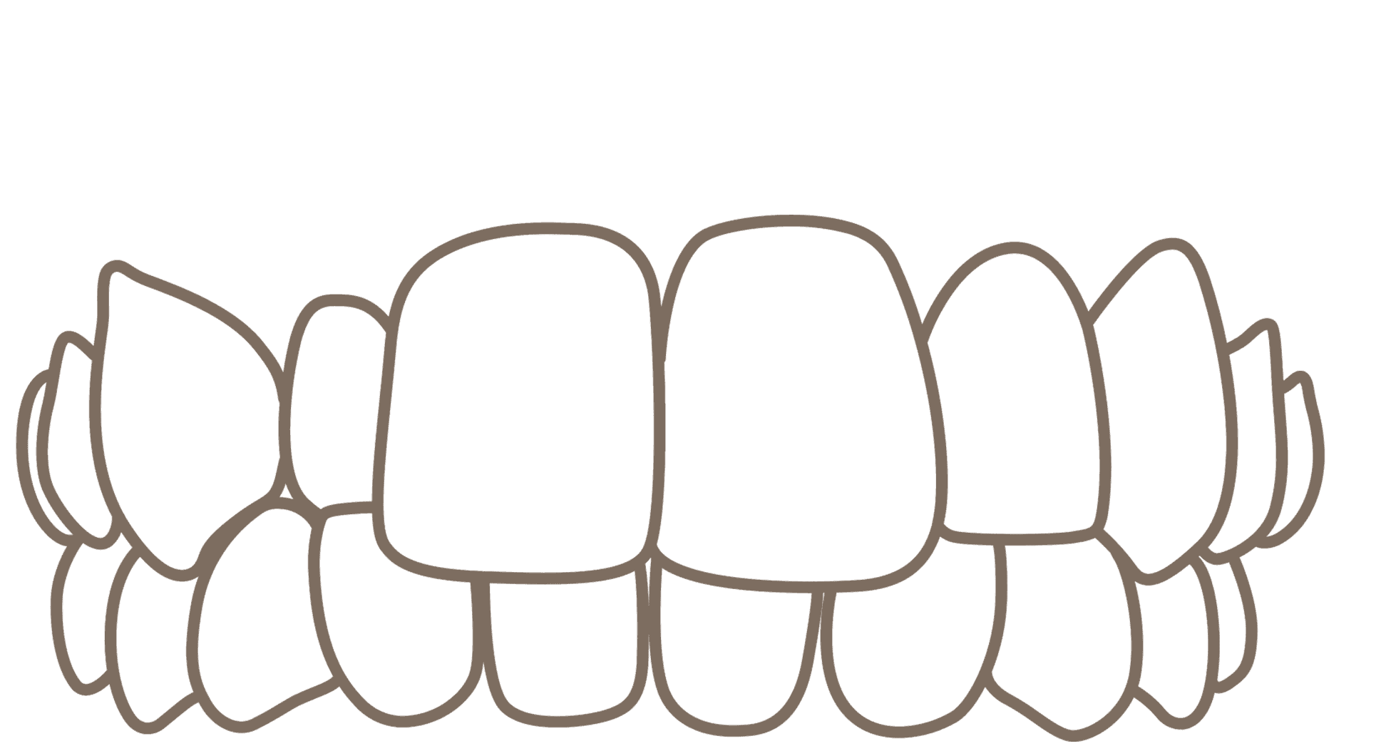 Ilustrasi Gigitan Silang (Crossbite)