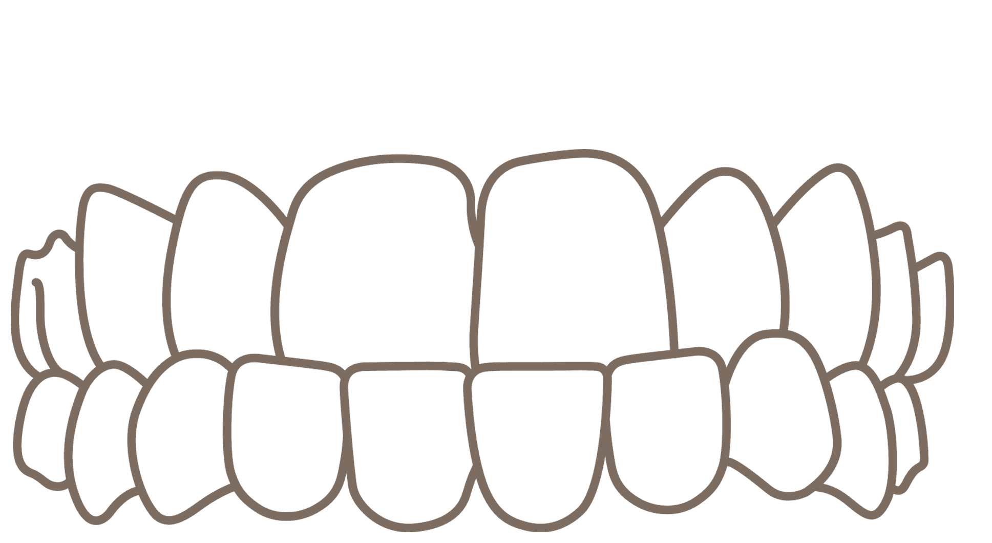 Ilustrasi Gigitan Terbalik (Underbite)