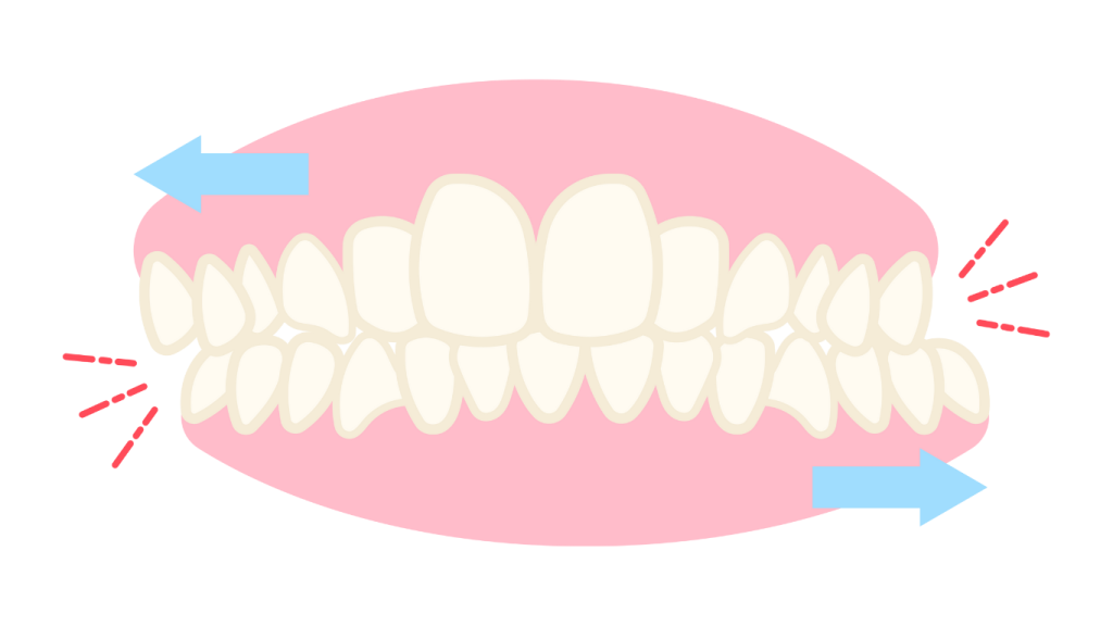 Can Invisalign Fix Different Bit Issues