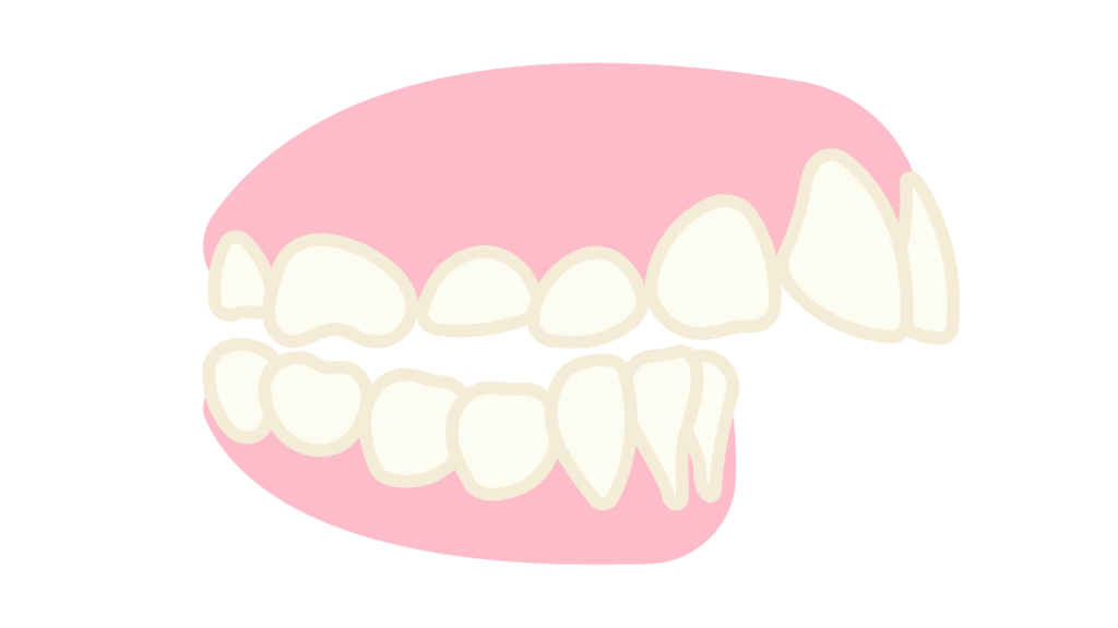 Can Invisalign Fix Different Bit Issues