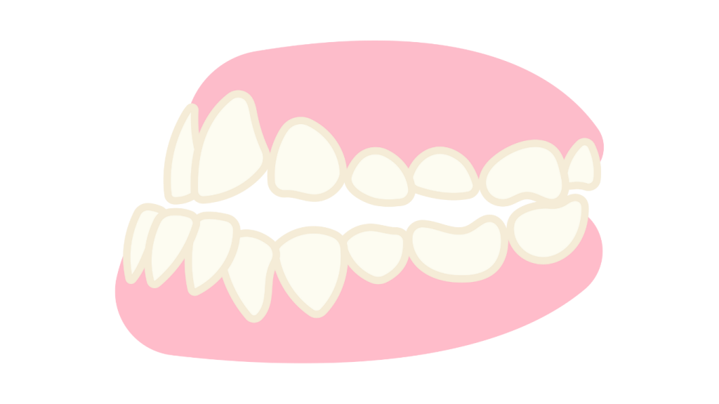 Can Invisalign Fix Different Bit Issues